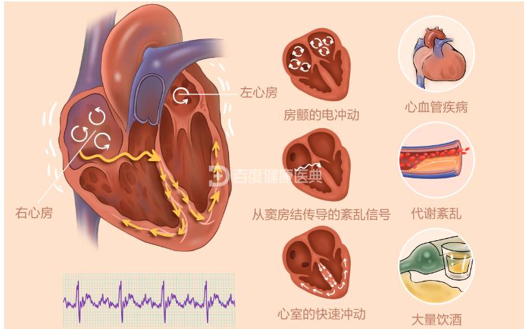 房颤的最新分类及其临床意义概述